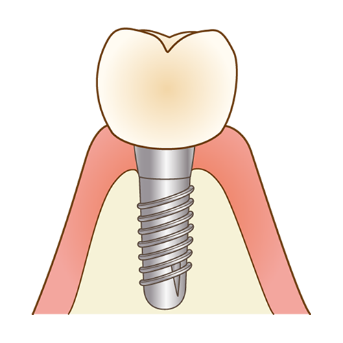 インプラント